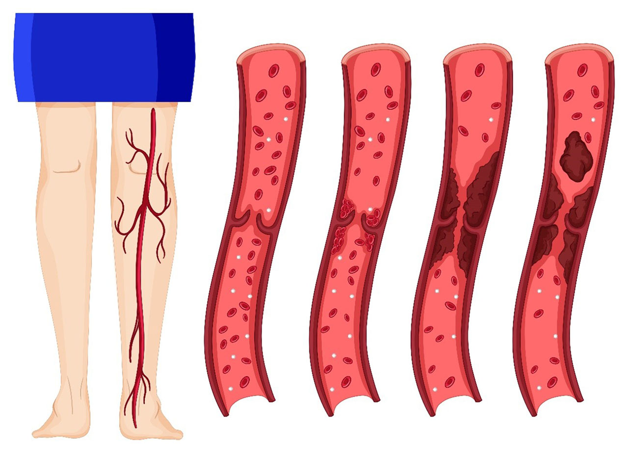processo de trombose nas veias da perna